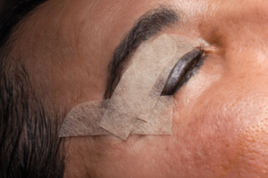 Genesung nach einer Blepharoplastik
