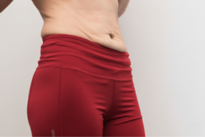 Plissement ou relâchement de la peau après une liposuccion
