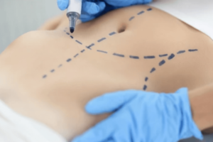 Risques et complications liés à une liposuccion